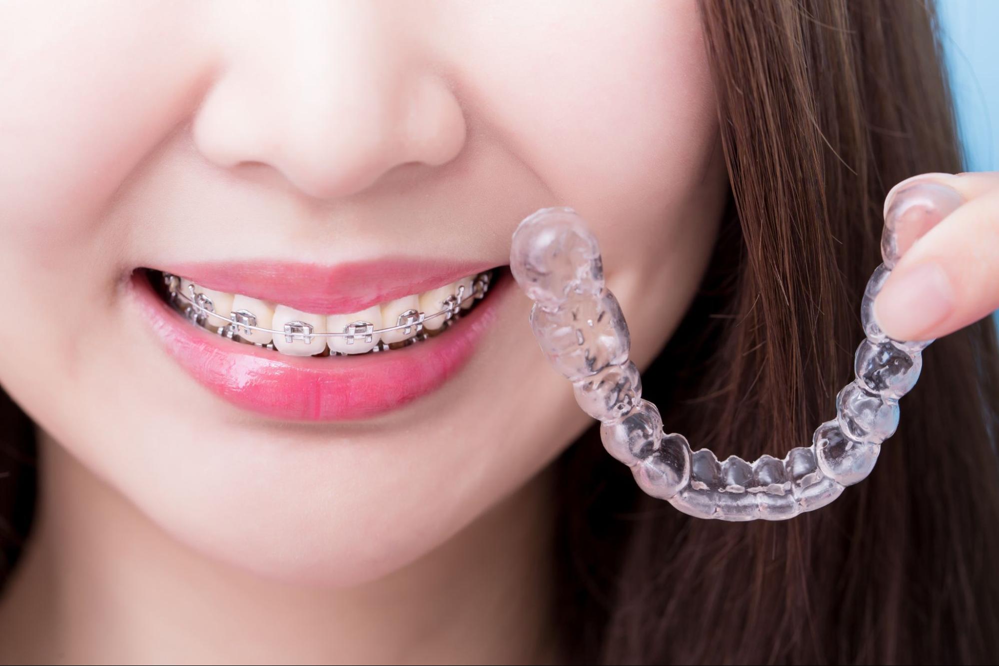 Orthodontic FAQs